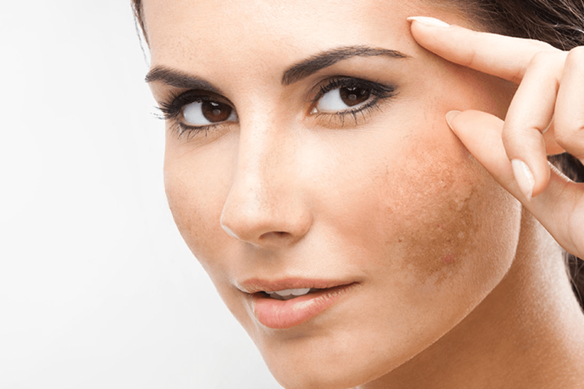 melasma